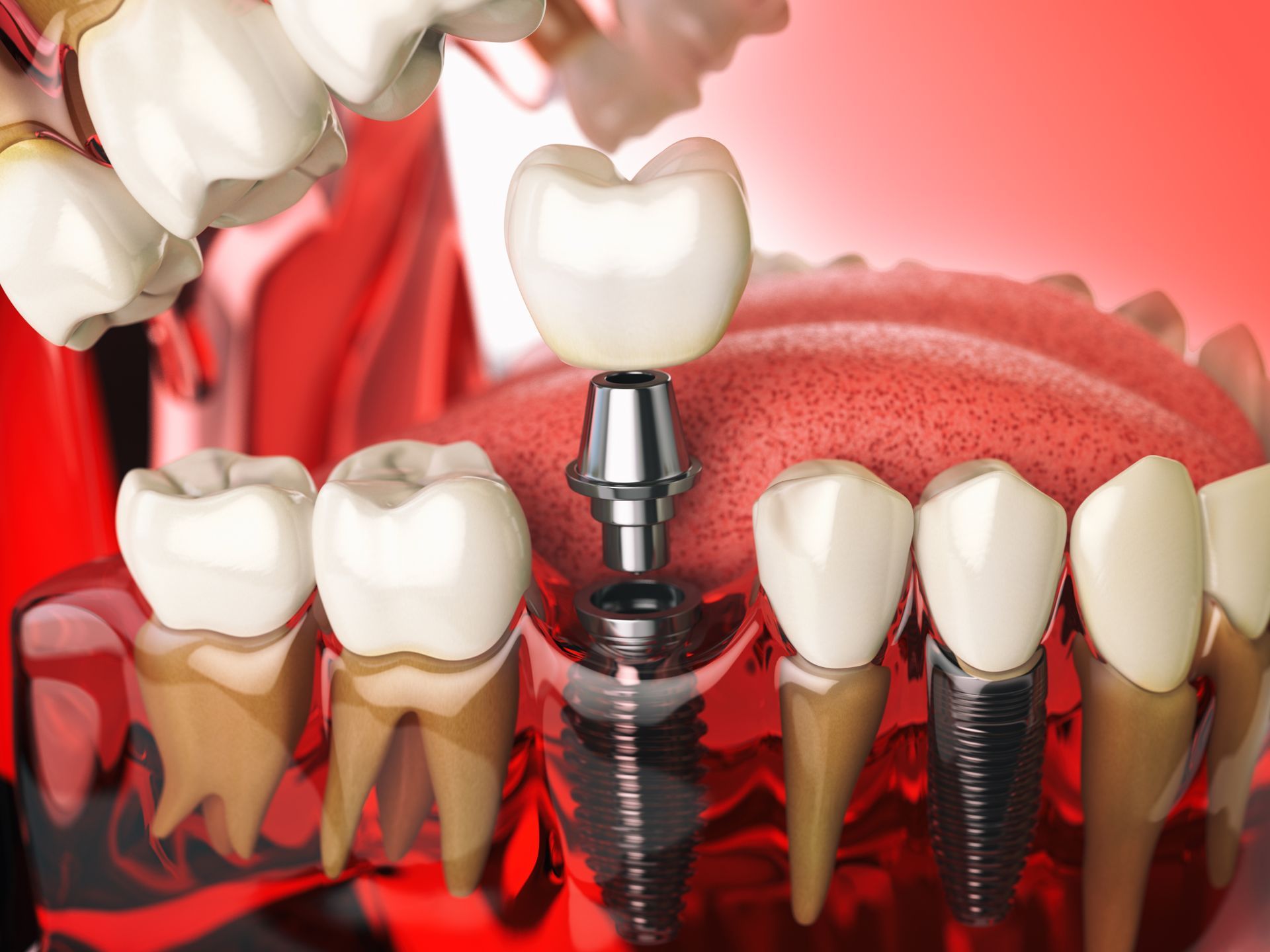A close up of a dental implant in a row of teeth.