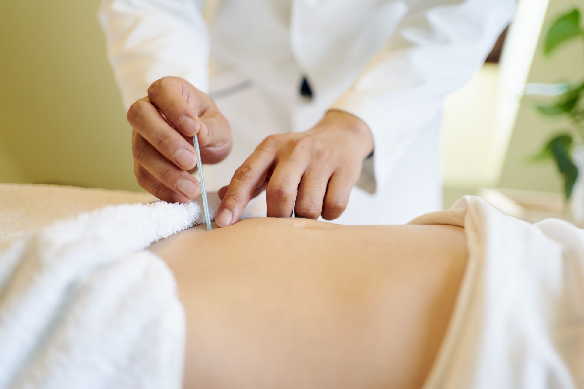 A person is getting an acupuncture treatment on their back.