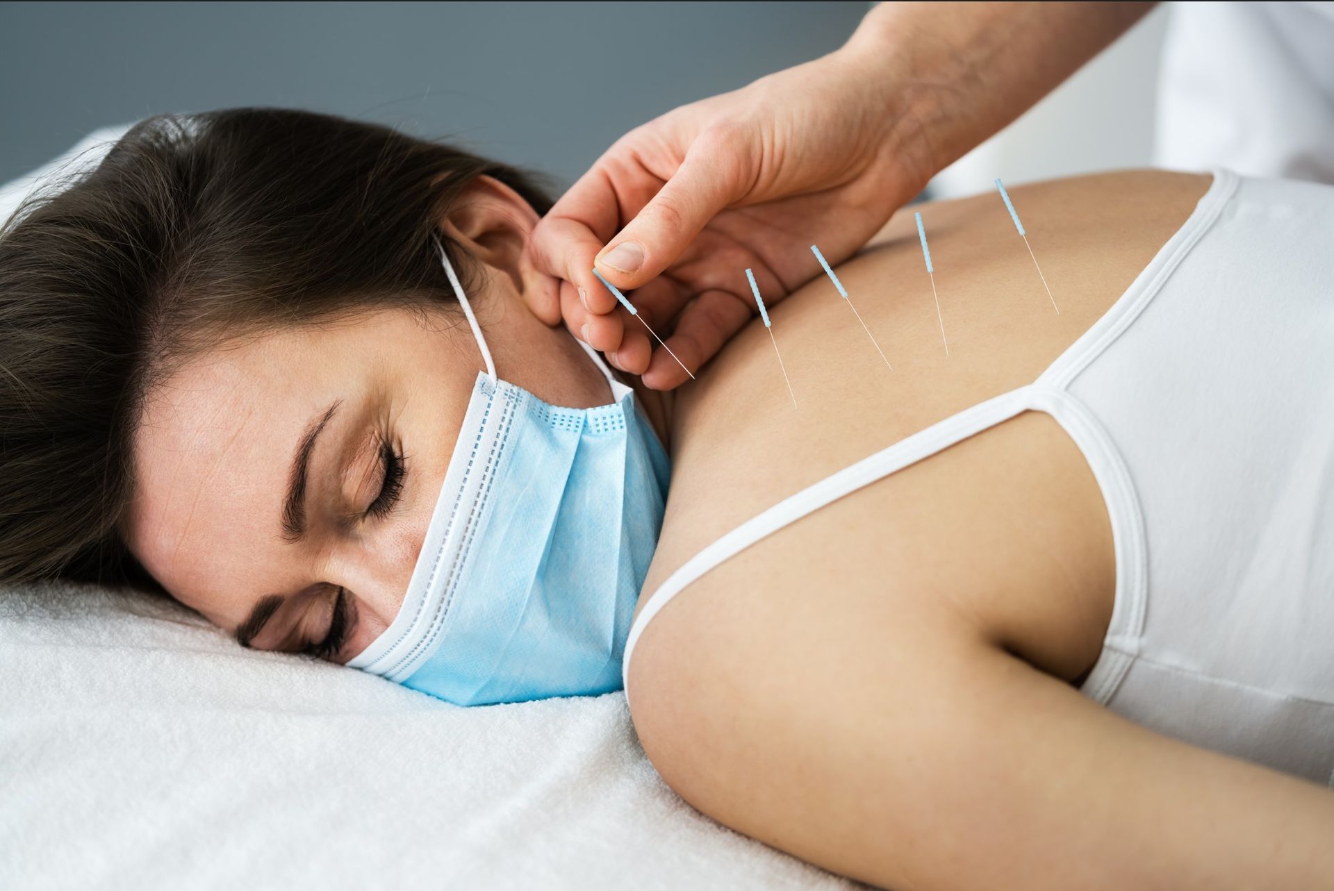 A woman wearing a face mask is getting acupuncture.