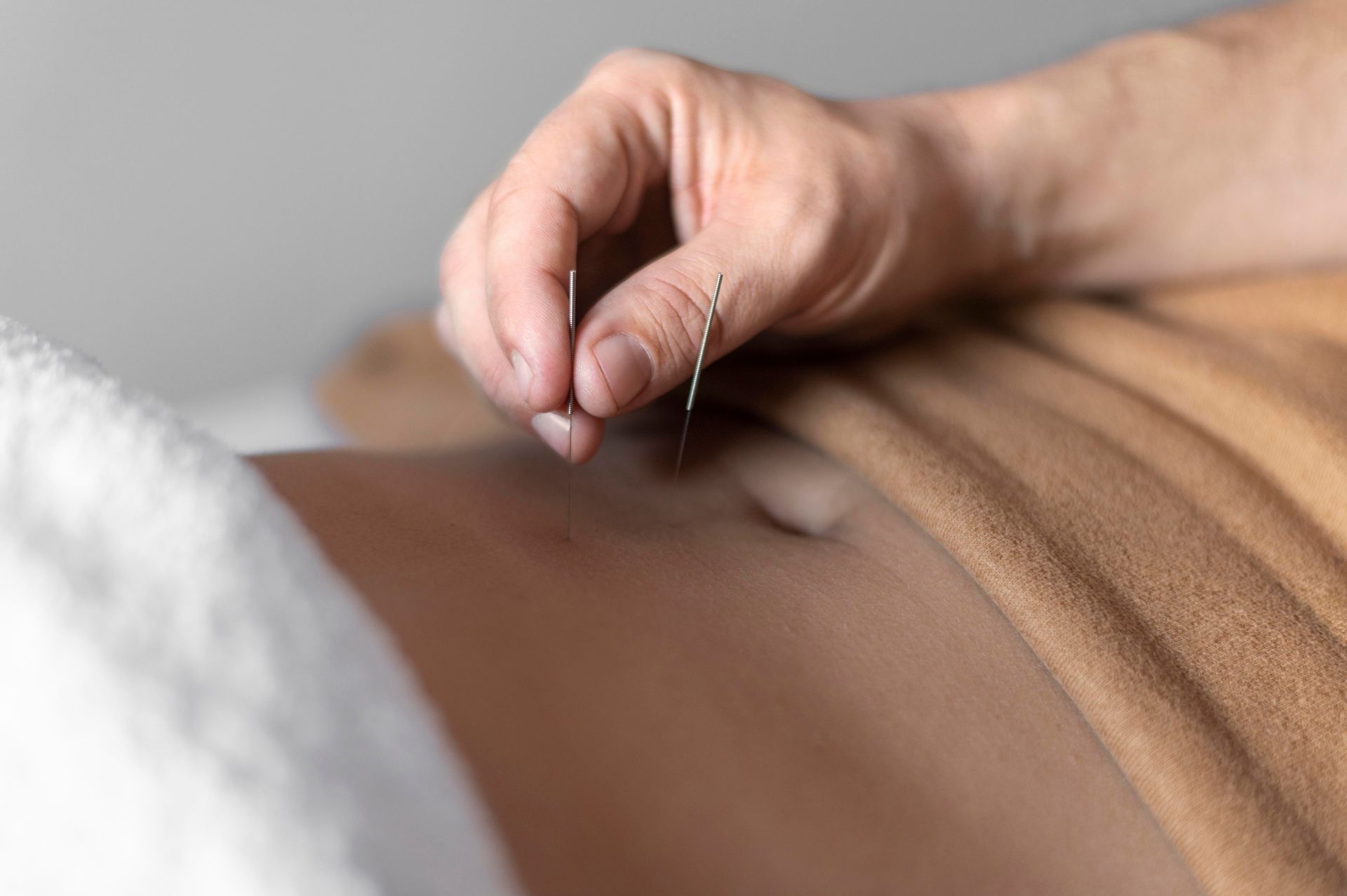 A person is getting acupuncture on their back.