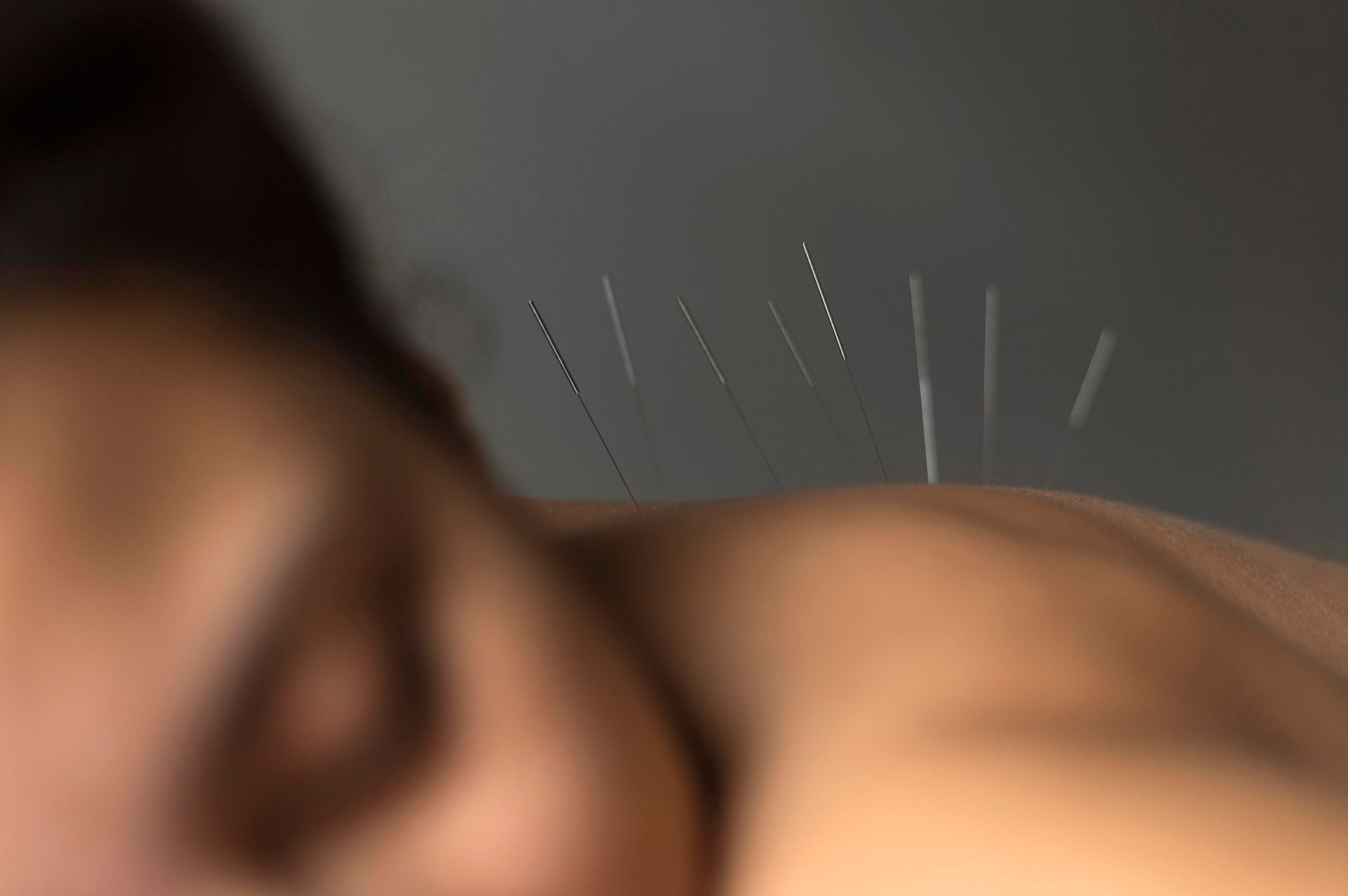 A close up of a person getting acupuncture on their back.