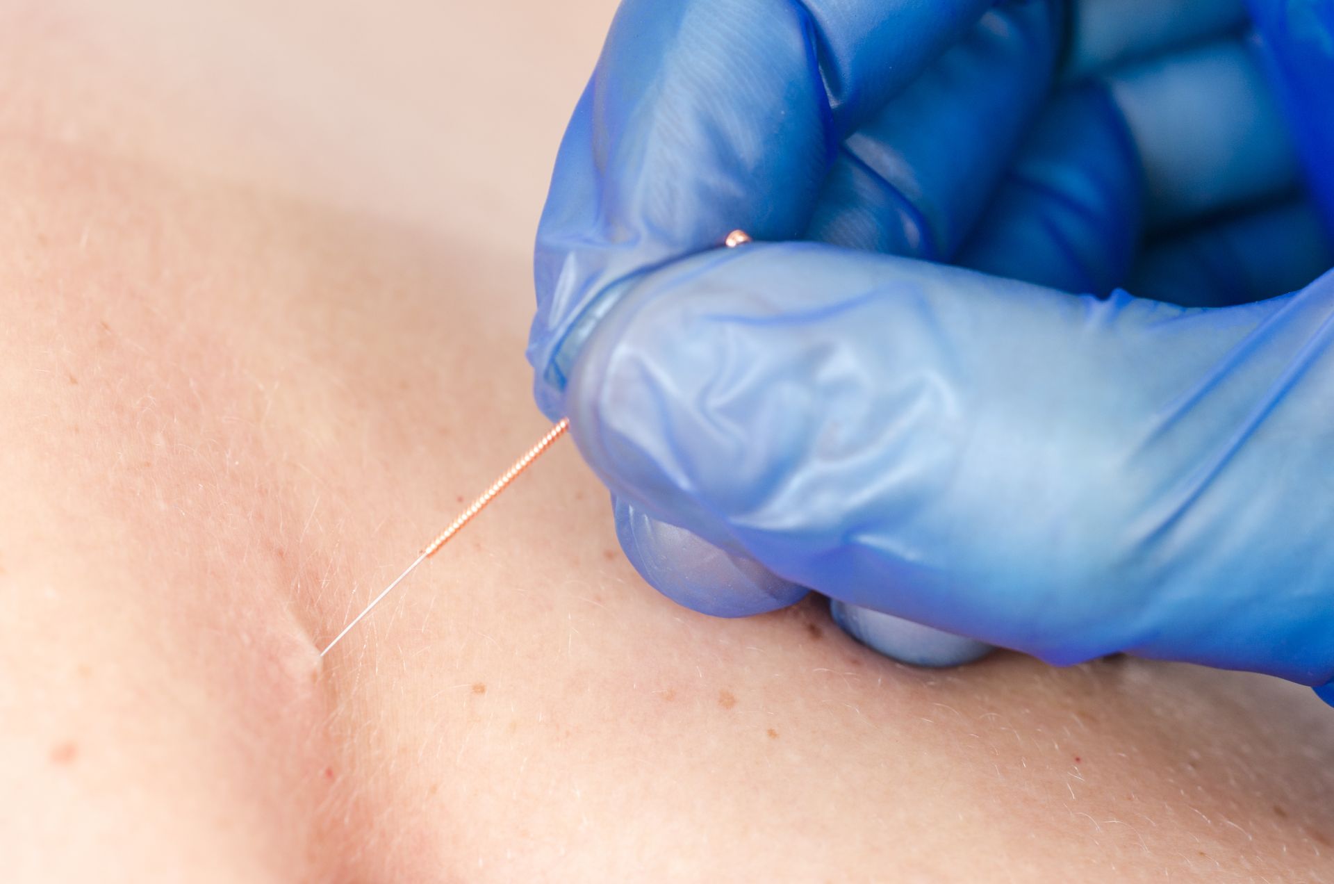 A person is getting acupuncture on their back.