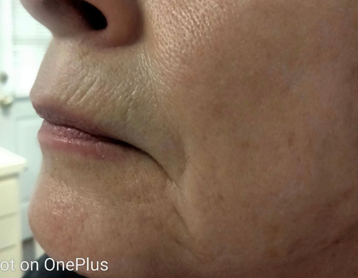 Close-up of a person's lower face, showing lips, wrinkles, and skin texture.