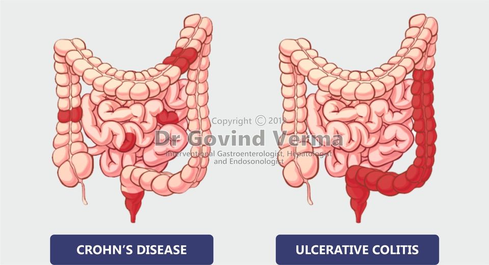 Inflammatory Bowel Disease - Crohn's disease, Ulcerative colitis