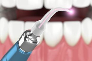 A close up of a person 's teeth with a laser being used