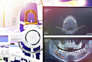 A computer monitor shows a dental x-ray of a person 's teeth.