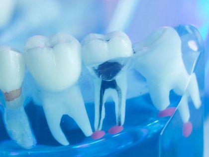 A close up of a model of teeth with holes in them.
