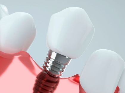 A close up of a dental implant in a tooth.