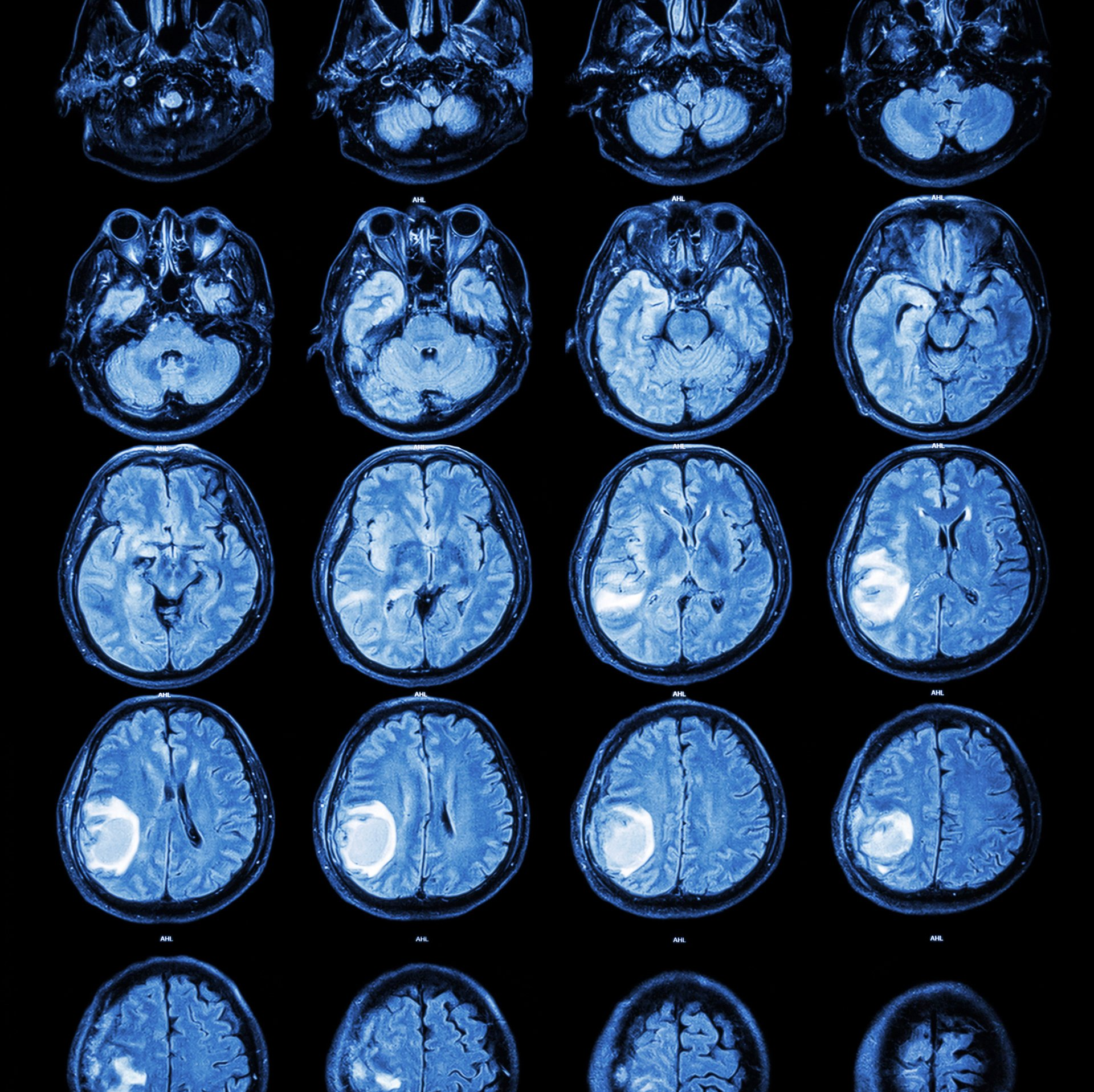 Médico para tratar tumor cerebral na Barra da Tijuca