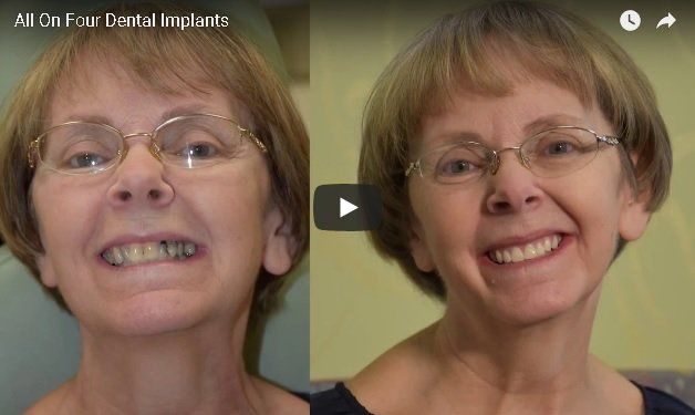 All On Four Dental Implants Change Lives