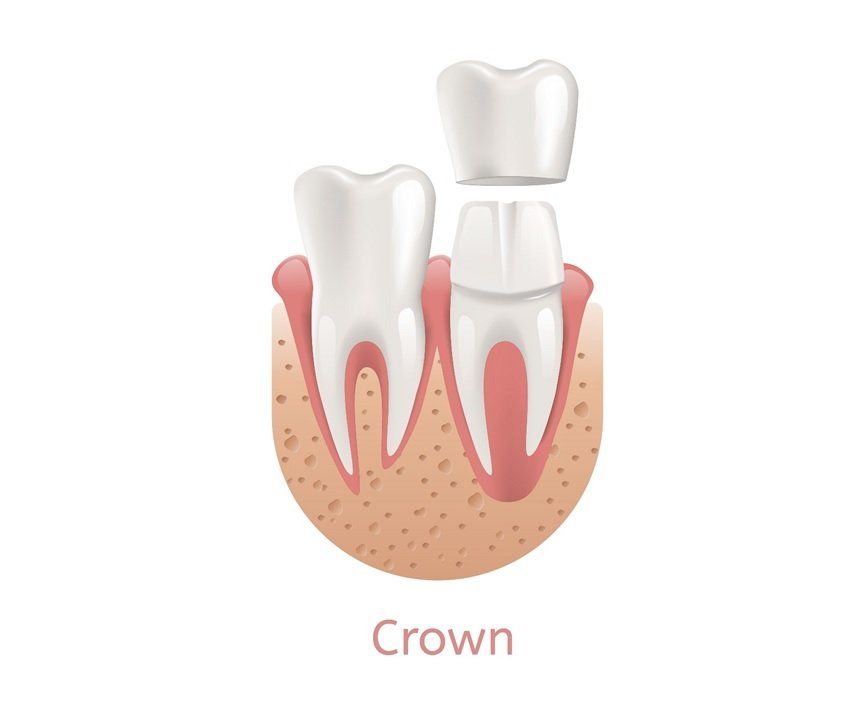 Same Day Dental Crown