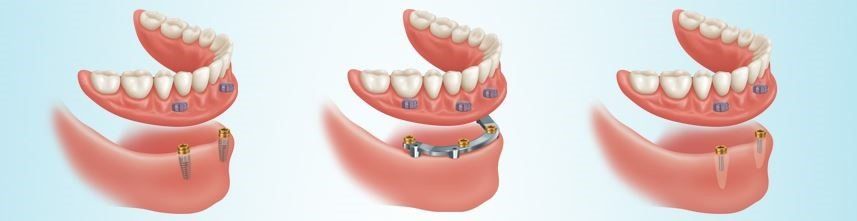 Implant Supported Denture Option