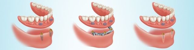 How to Apply DenSureFit to IMPLANT-RETAINED (snap-in) Dentures