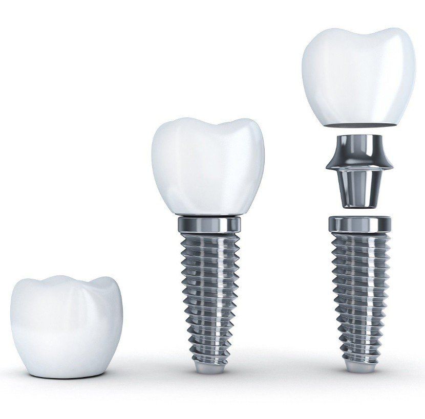 reasons for getting a dental implant