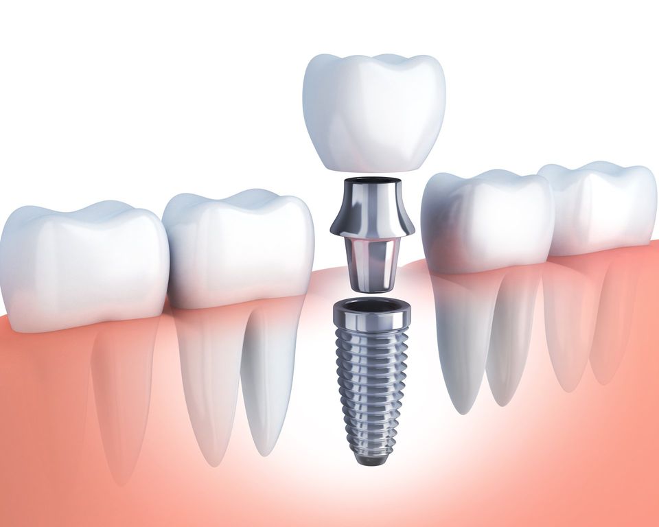 mini dental implant vs. traditional dental implant