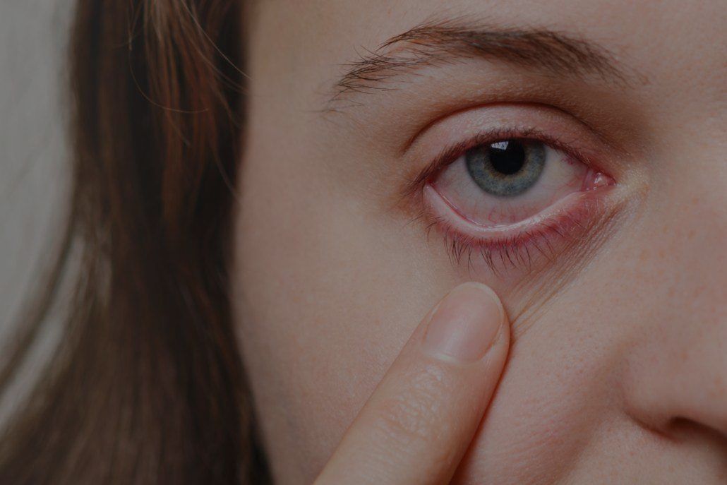 A woman with red eyes is touching her eye with her finger.