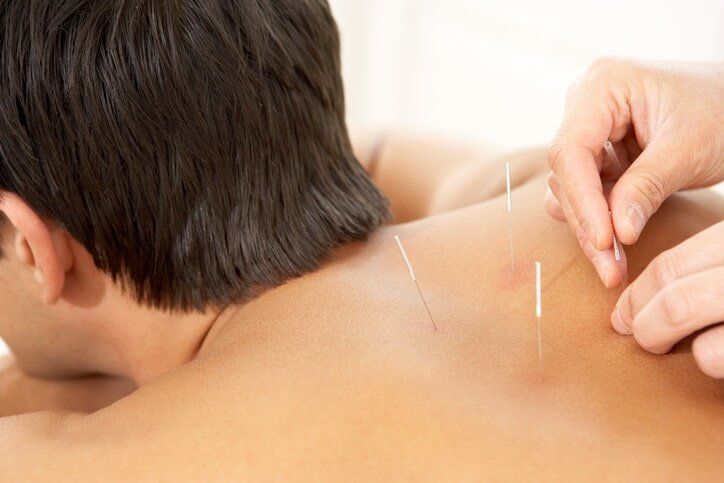 Acupuncture Treatment — Acupuncture in Sierra Vista, AZ