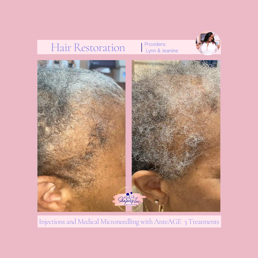 A before and after photo of a woman 's hair restoration.