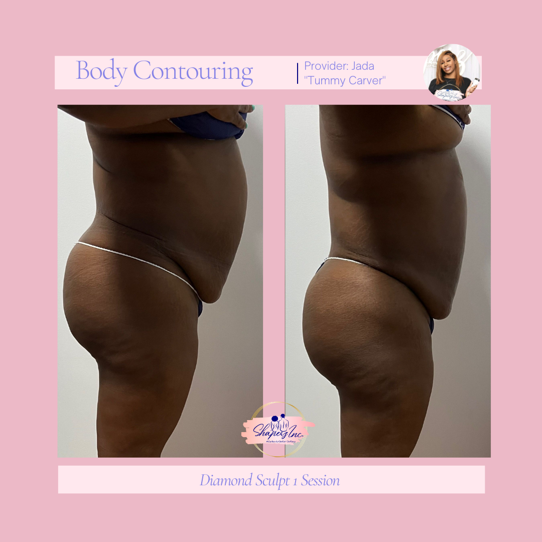 A woman is shown before and after a body contouring treatment.