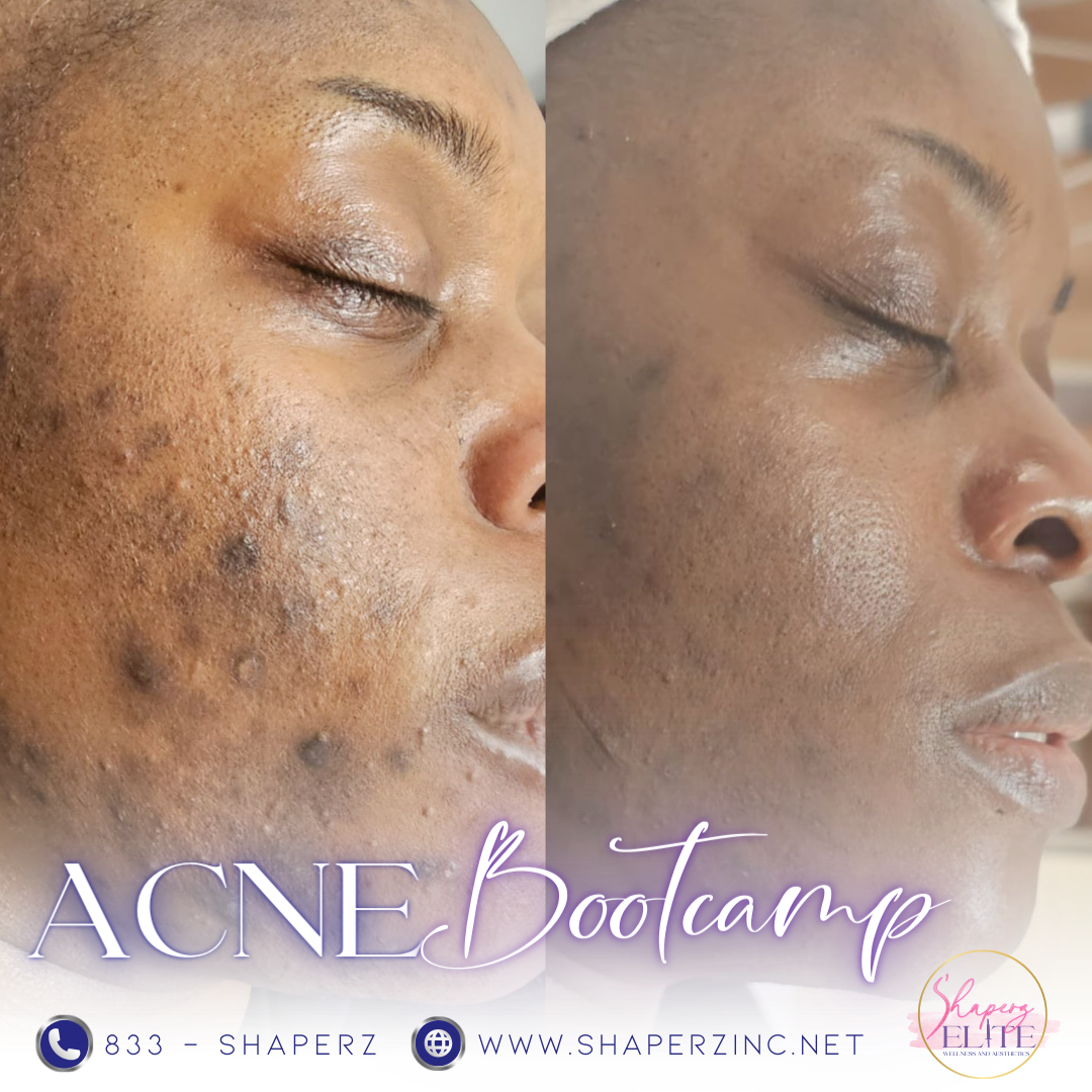 A woman 's face is shown before and after acne bootcamp