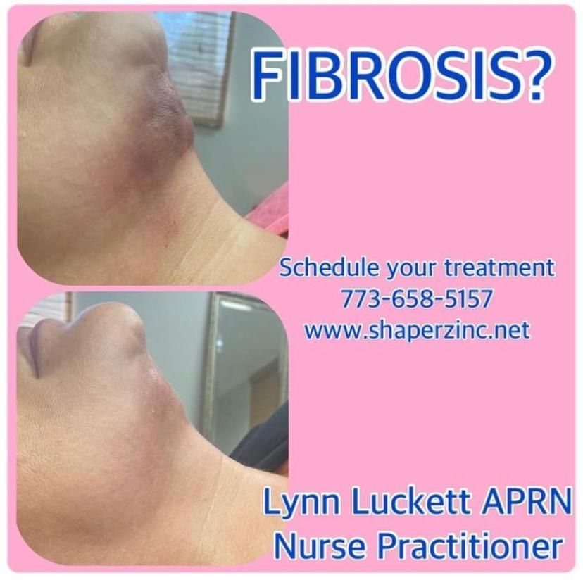 A picture of a person 's neck with the words fibrosis on it