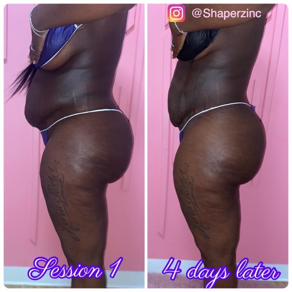 A before and after photo of a woman 's stomach.