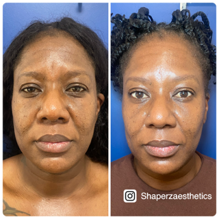 A before and after photo of a woman 's face by shaperzaesthetics