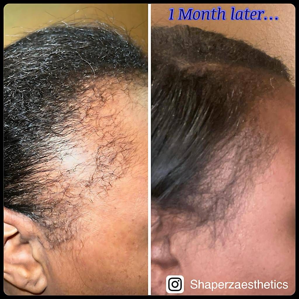 A before and after photo of a woman 's hair growth.