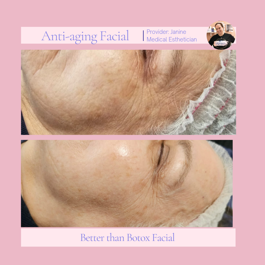 A woman 's face is shown before and after an anti-aging facial.