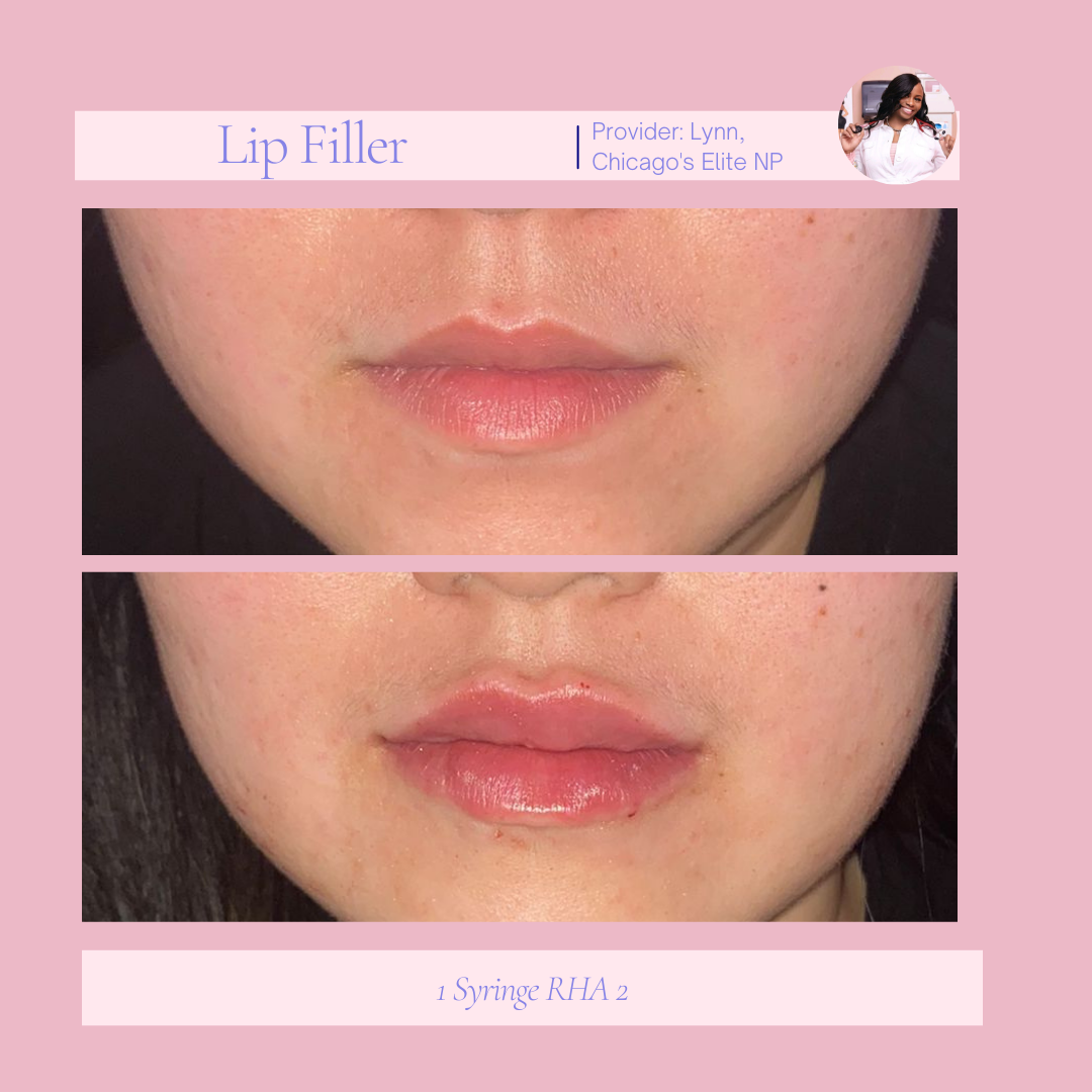 A before and after picture of a woman 's lips with lip filler