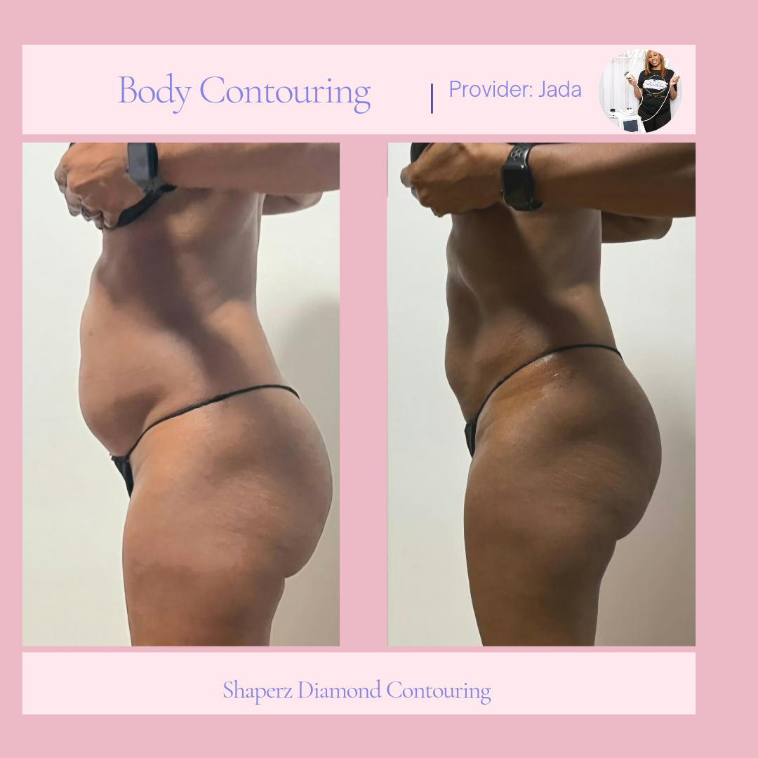 A before and after photo of a woman 's body contouring