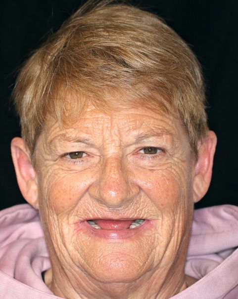 A close up of an elderly woman 's face with a missing tooth.