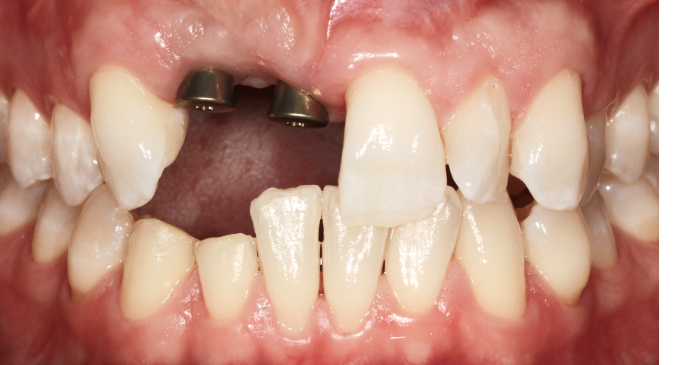 A close up of a person 's teeth with a missing tooth.