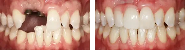 Montgomery Street Dental Before & After