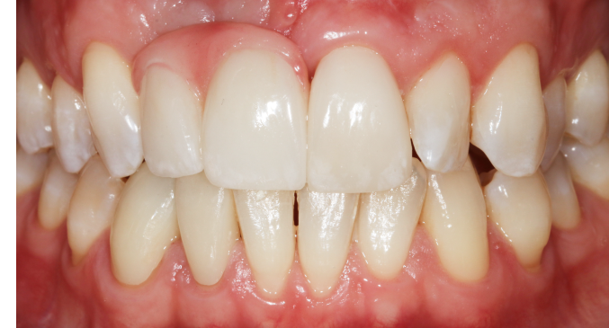 A close up of a person 's teeth and gums