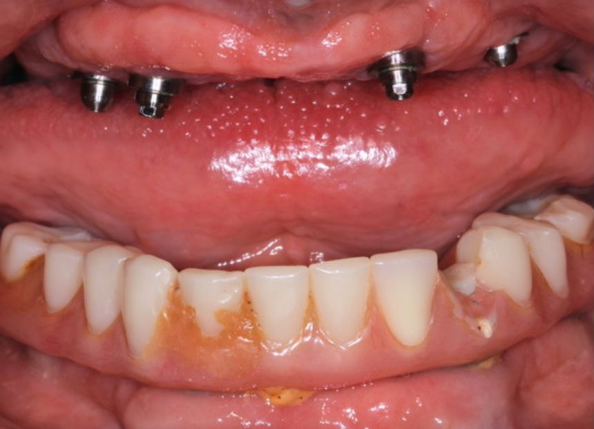 A close up of a person 's mouth with dental implants in it.