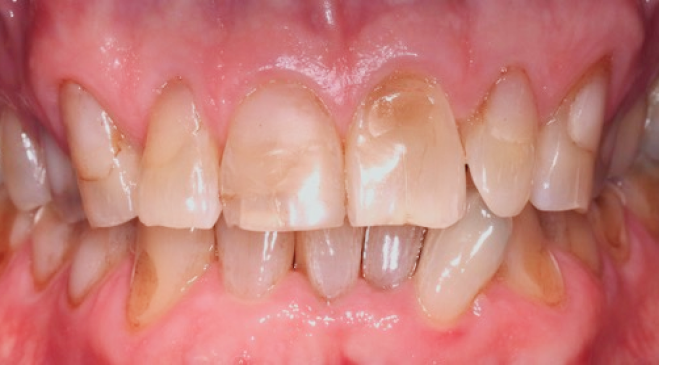 A close up of a person 's teeth with brown spots on them.