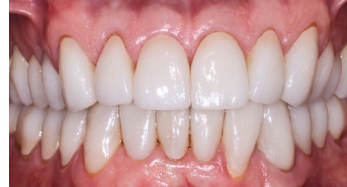 A close up of a person 's teeth with white teeth