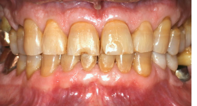 A close up of a person 's teeth and gums.