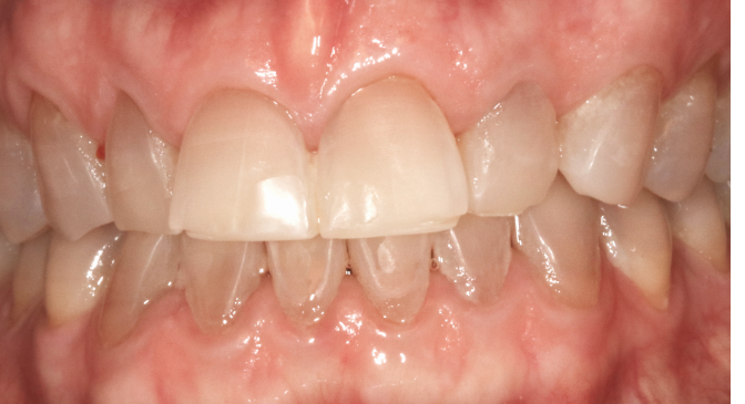 A close up of a person 's teeth and gums.