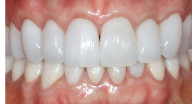 A close up of a person 's teeth with white teeth