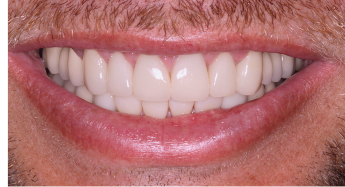 A close up of a man 's mouth with white teeth.