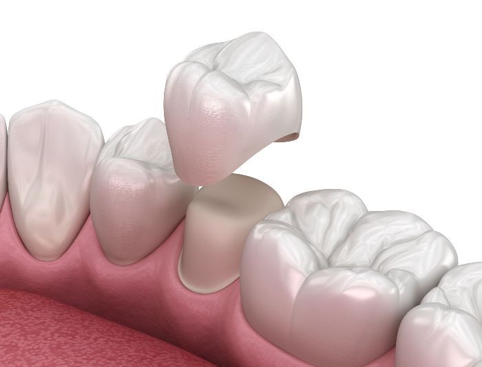 dental crowns