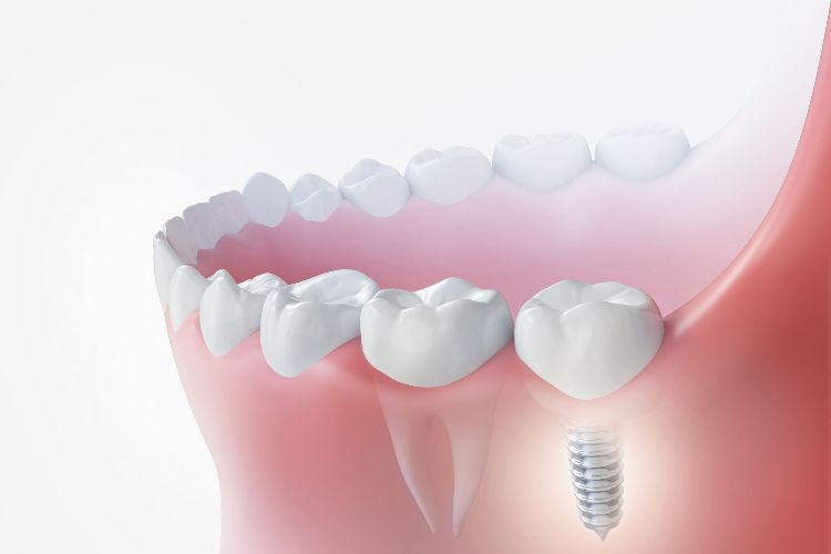 dental implants