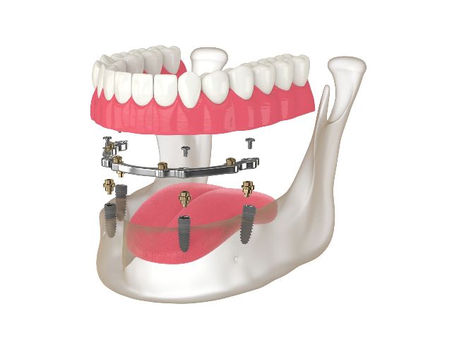 implant dentures