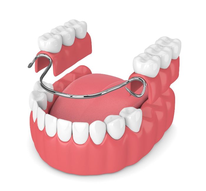 partial dentures