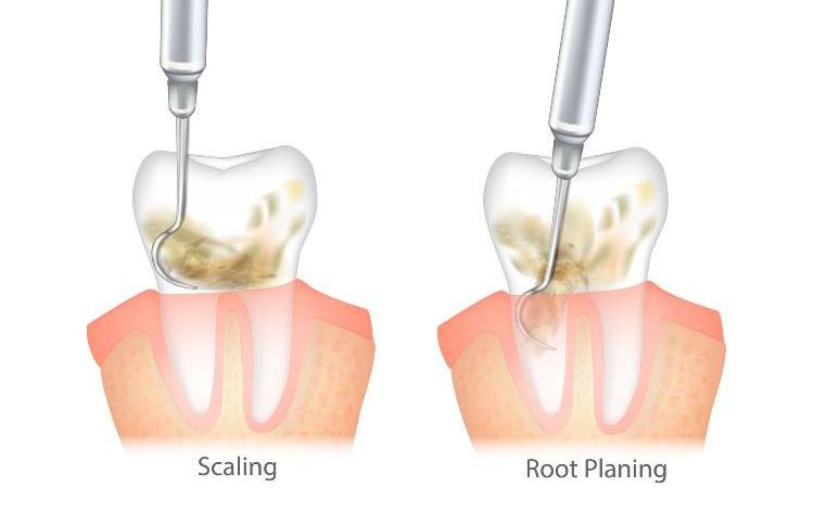 Scaling and root planing