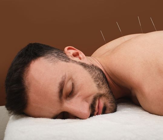 Man receiving acupuncture on his back