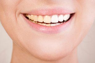 Root canal treatment — Before and after Teeth whitening in Sacramento, CA