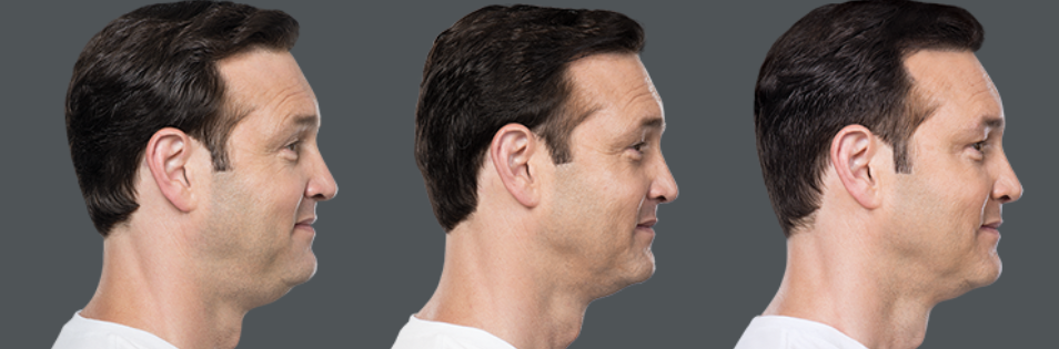 kybella treatment progression on middle-aged man